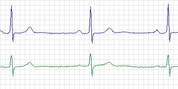 Electrocardiogram for MIT-BIH Arrhythmia, record 123