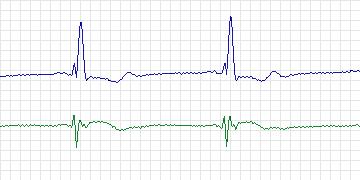 Electrocardiogram for MIT-BIH Arrhythmia, record 124