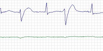 Electrocardiogram for MIT-BIH Arrhythmia, record 200