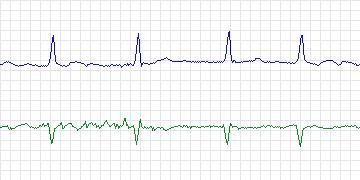 Electrocardiogram for MIT-BIH Arrhythmia, record 201