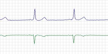Electrocardiogram for MIT-BIH Arrhythmia, record 202