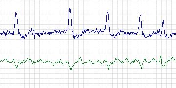 Electrocardiogram for MIT-BIH Arrhythmia, record 203