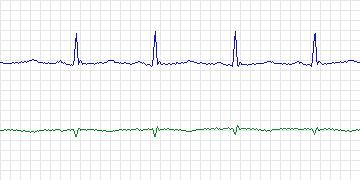 Electrocardiogram for MIT-BIH Arrhythmia, record 205