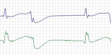 Electrocardiogram for MIT-BIH Arrhythmia, record 207
