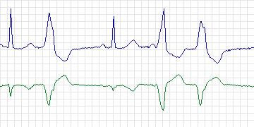 Electrocardiogram for MIT-BIH Arrhythmia, record 208