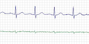 Electrocardiogram for MIT-BIH Arrhythmia, record 209