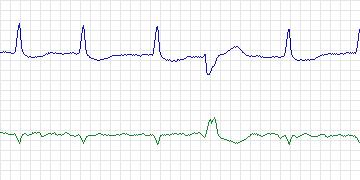 Electrocardiogram for MIT-BIH Arrhythmia, record 210