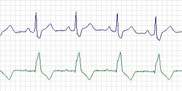 Electrocardiogram for MIT-BIH Arrhythmia, record 212