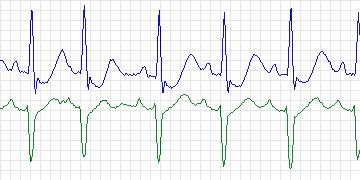 Electrocardiogram for MIT-BIH Arrhythmia, record 213