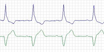 Electrocardiogram for MIT-BIH Arrhythmia, record 214