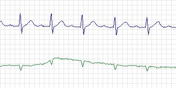 Electrocardiogram for MIT-BIH Arrhythmia, record 215
