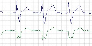 Electrocardiogram for MIT-BIH Arrhythmia, record 217