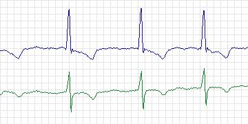 Electrocardiogram for MIT-BIH Arrhythmia, record 219