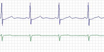 Electrocardiogram for MIT-BIH Arrhythmia, record 220