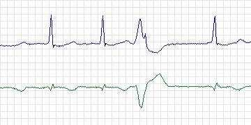 Electrocardiogram for MIT-BIH Arrhythmia, record 221