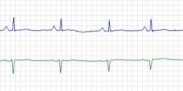 Electrocardiogram for MIT-BIH Arrhythmia, record 222