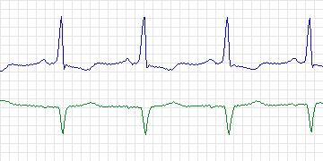 Electrocardiogram for MIT-BIH Arrhythmia, record 223
