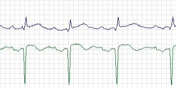 Electrocardiogram for MIT-BIH Arrhythmia, record 228
