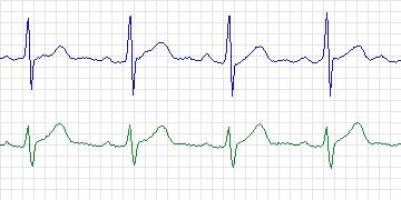 Electrocardiogram for MIT-BIH Arrhythmia, record 230