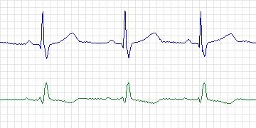 Electrocardiogram for MIT-BIH Arrhythmia, record 231