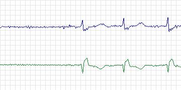 Electrocardiogram for MIT-BIH Arrhythmia, record 232