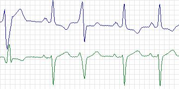Electrocardiogram for MIT-BIH Arrhythmia, record 233