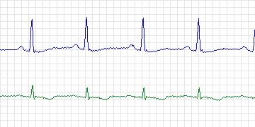 Electrocardiogram for MIT-BIH Arrhythmia, record 234