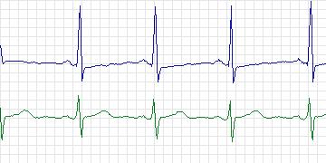 Electrocardiogram for MIT-BIH Normal Sinus Rhythm, record 17453