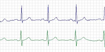 Electrocardiogram for MIT-BIH Normal Sinus Rhythm, record 18184