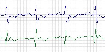 Electrocardiogram for MIT-BIH Noise Stress Test, record 118e_6