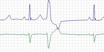 Electrocardiogram for MIT-BIH Noise Stress Test, record 119e00