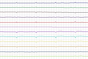 Electrocardiogram for PTB Diagnostic ECG, record s0022lre-patient006