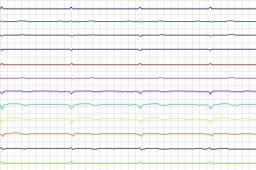 Electrocardiogram for PTB Diagnostic ECG, record s0026lre-patient007