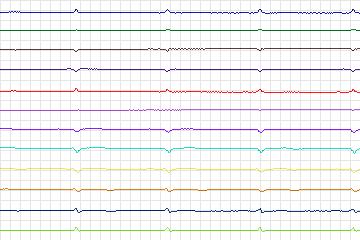Electrocardiogram for PTB Diagnostic ECG, record s0027lre-patient006