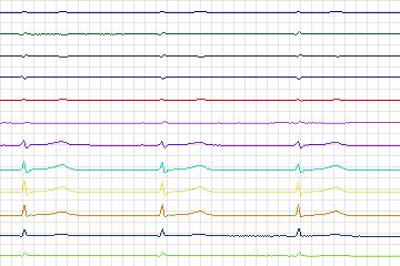 Electrocardiogram for PTB Diagnostic ECG, record s0028lre-patient008