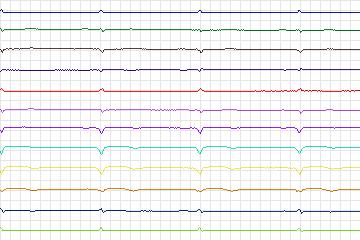 Electrocardiogram for PTB Diagnostic ECG, record s0029lre-patient007
