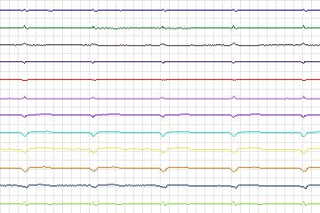 Electrocardiogram for PTB Diagnostic ECG, record s0031lre-patient005