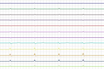 Electrocardiogram for PTB Diagnostic ECG, record s0035_re-patient009