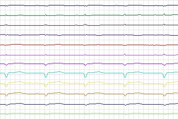 Electrocardiogram for PTB Diagnostic ECG, record s0036lre-patient010