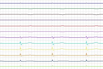 Electrocardiogram for PTB Diagnostic ECG, record s0037lre-patient008