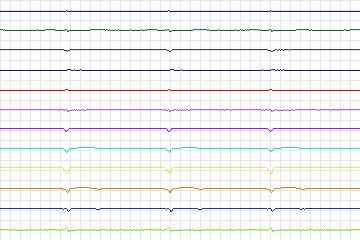Electrocardiogram for PTB Diagnostic ECG, record s0038lre-patient007
