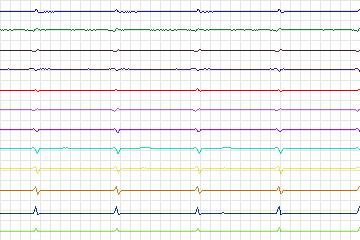 Electrocardiogram for PTB Diagnostic ECG, record s0039lre-patient011