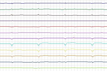 Electrocardiogram for PTB Diagnostic ECG, record s0042lre-patient010
