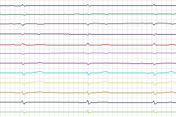 Electrocardiogram for PTB Diagnostic ECG, record s0043lre-patient012