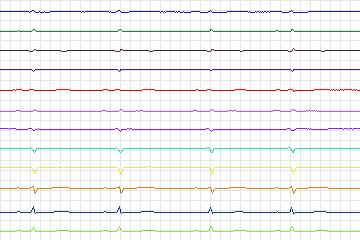 Electrocardiogram for PTB Diagnostic ECG, record s0044lre-patient011
