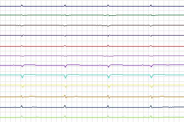 Electrocardiogram for PTB Diagnostic ECG, record s0045lre-patient013