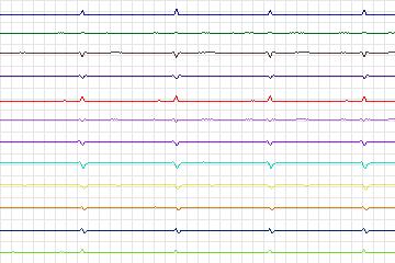 Electrocardiogram for PTB Diagnostic ECG, record s0046lre-patient014