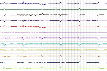 Electrocardiogram for PTB Diagnostic ECG, record s0047lre-patient015