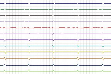 Electrocardiogram for PTB Diagnostic ECG, record s0049lre-patient011