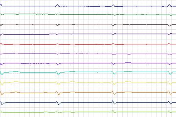 Electrocardiogram for PTB Diagnostic ECG, record s0050lre-patient012